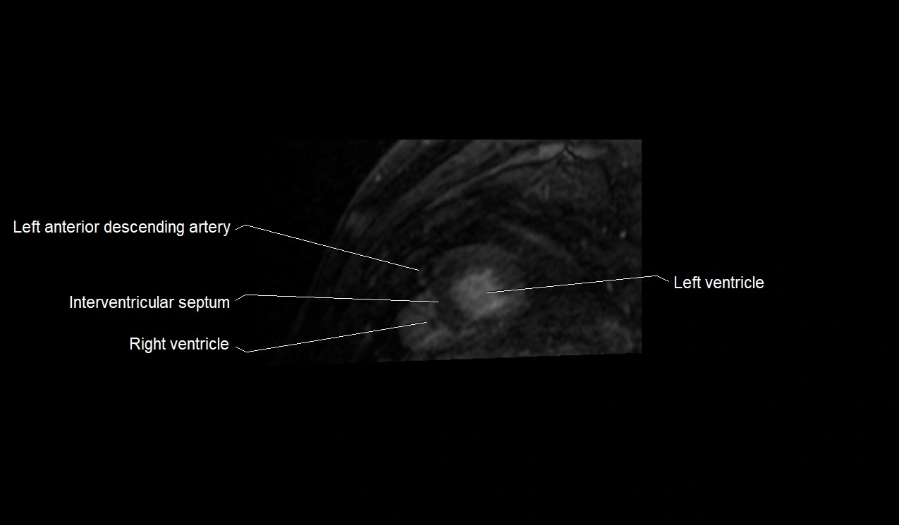 MRI heart and coronary arteries short axis anatomy image 37.webp